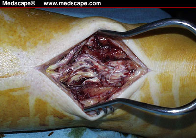 Achilles tendon rupture 2.jpg