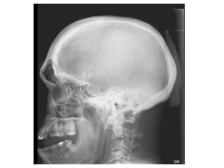 Acromegalic skull x-ray.jpg