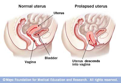 Uterine prolapse mayoclinic.jpg