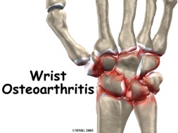 图片:Wrist_osteoarthritis_intro01.jpg