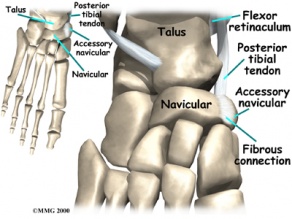 Foot accessory navicular clinical antomy 2.jpg