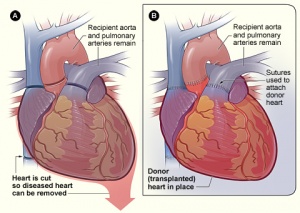 心脏移植NIH.jpg