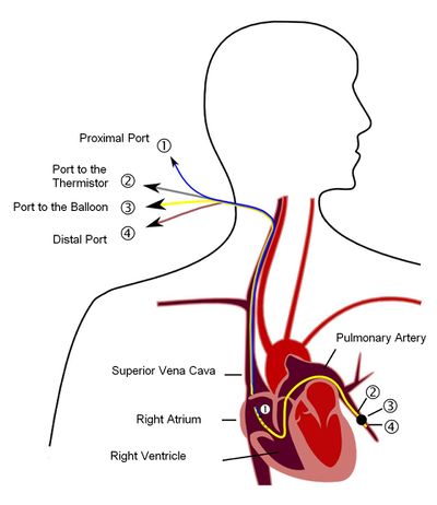 肺动脉导管