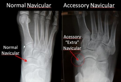 Normal-Navicular-and-Accessory-Navicular.jpg